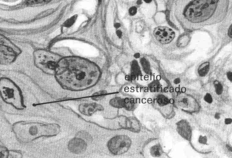 cancro-intestino.jpg